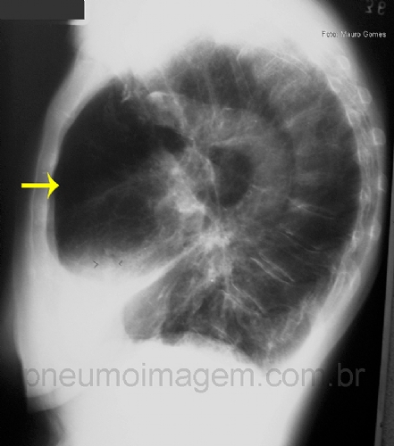 PACIENTES COM DPOC S�O SUBTRATADOS PARA DOEN�A CARDIOVASCULAR
